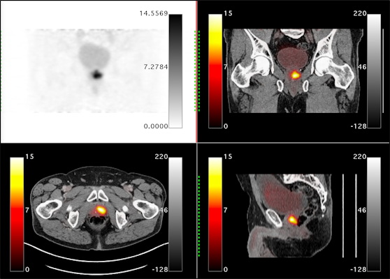 Orthogonal views are shown for a 65 year old male Orthogonal views are shown for a 65 year old male