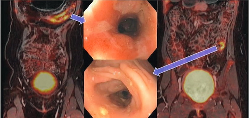 An image presented by Anthony Jiang of the University of Wisconsin during a talk on the added value of FDG PET in Crohn